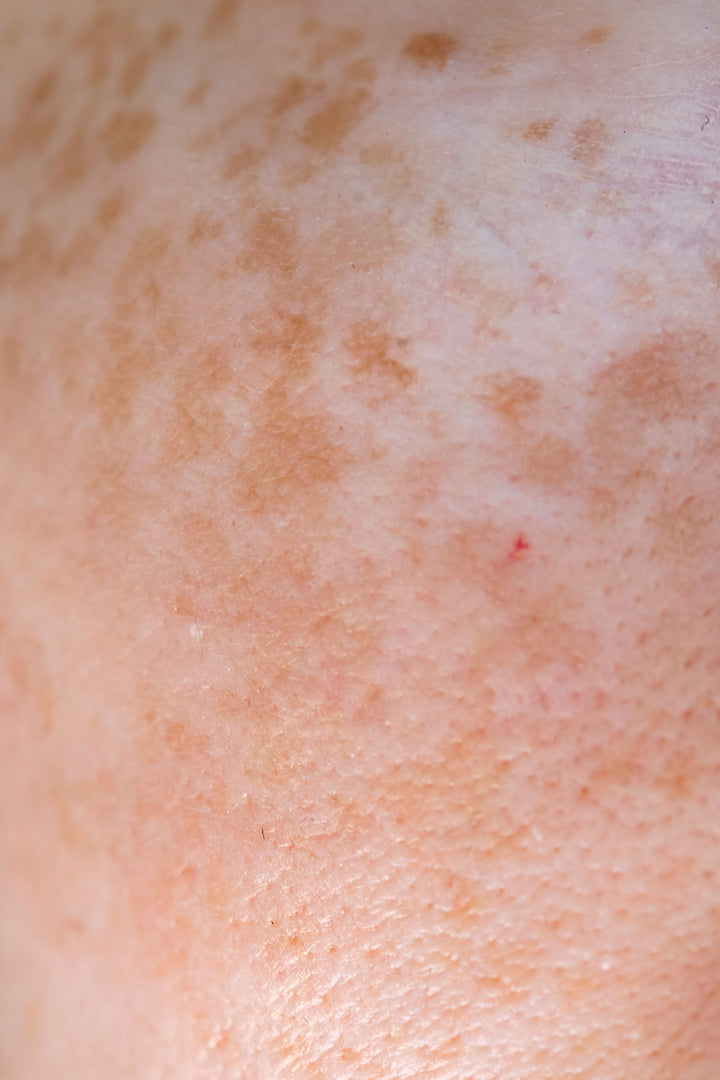 Ayurvedic Remedies for Pigmentation: What Actually Works